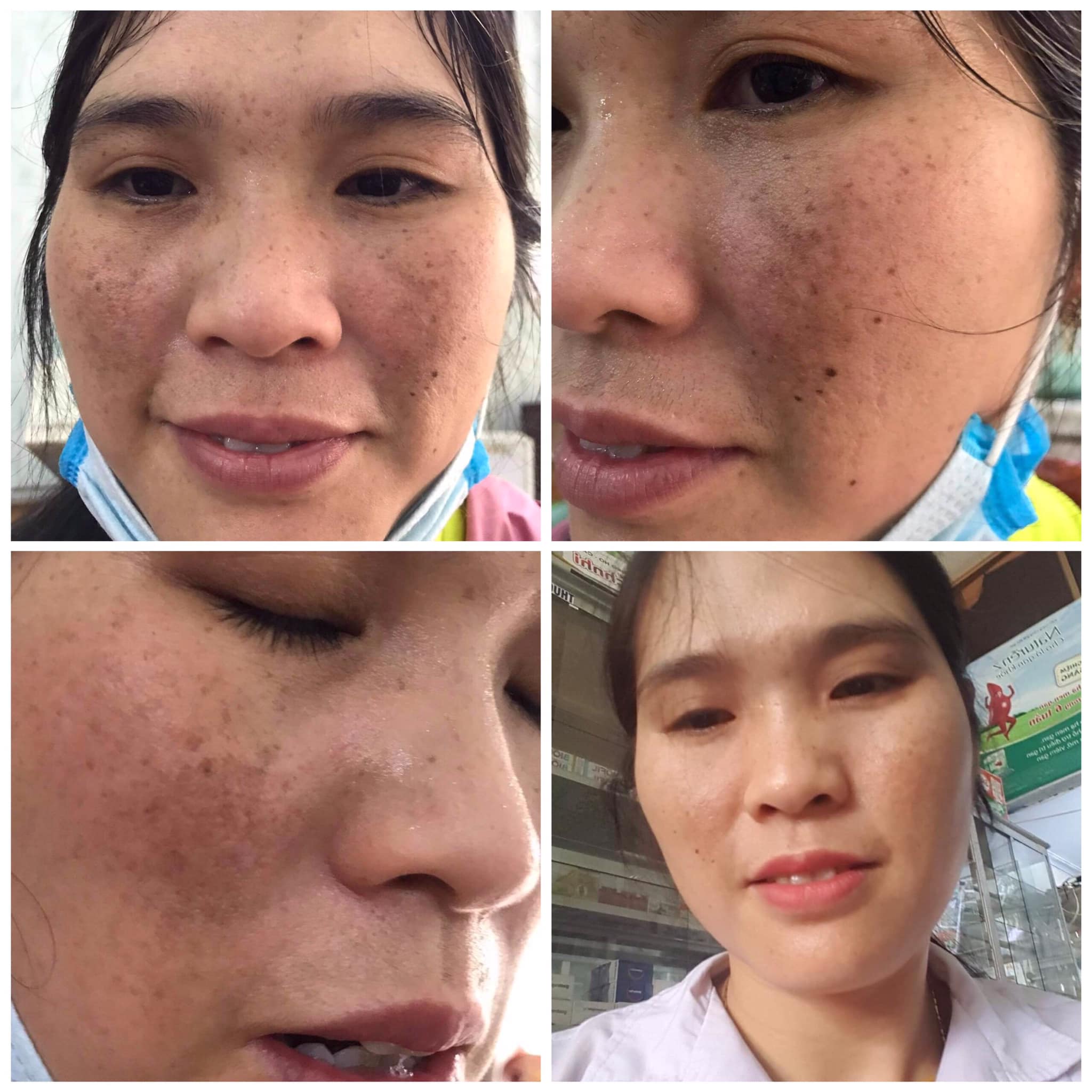 KEM TRỊ NÁM QUIN CAO CẤP