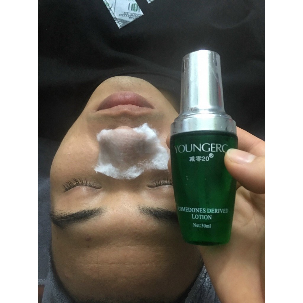 Ủ Mụn đầu đen, mụn cám Young Erc chai 30ml - SPA88