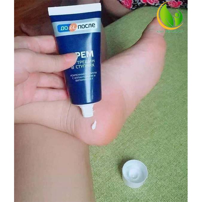 Nứt gót chân Nga Kpem dưỡng ẩm làm mềm gót chân