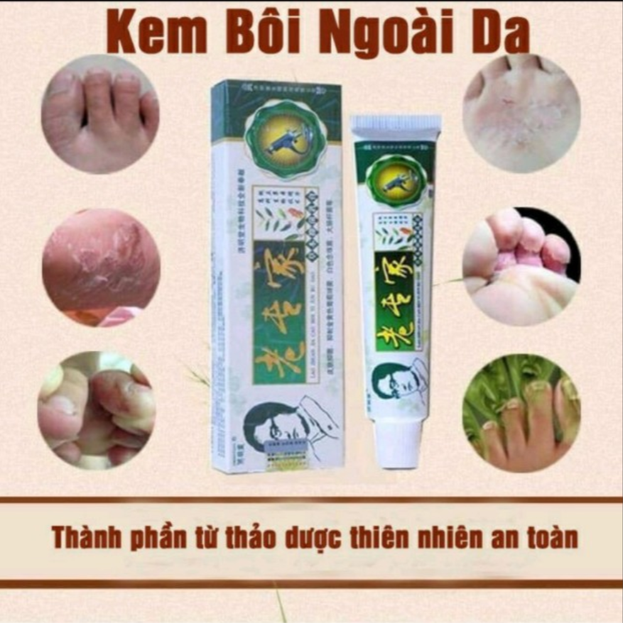 Kem bôi nấm ngứa á sừng