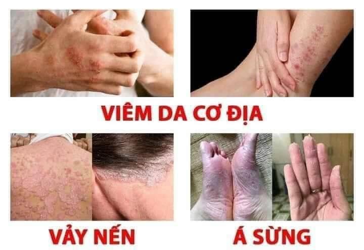 kem bôi nấm, hắc lào, lang ben