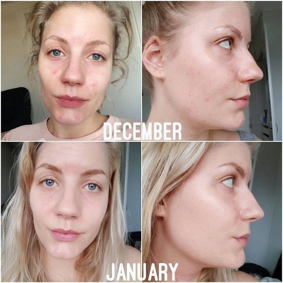 Serum The Ordinary Niacinamide 10% + Zinc 2%