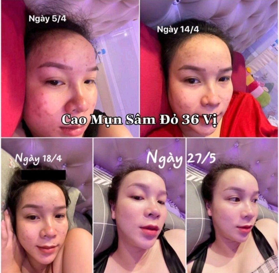 Cao Mụn Sâm Đỏ 36 Vị