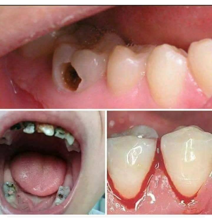 THUOC Đ.Ặ.C TR.Ị SÂU RĂNG PHÚ ÂN - CAM KẾT KHỎI DỨT ĐIỂM BỆNH RĂNG MIỆNG - NPP PIONE BOSS điều tr.ị sâu răng, sún răng, nhiệt miệng, hôi miệng, nấm lưỡi, viêm lợi, chảy máu chân răng...