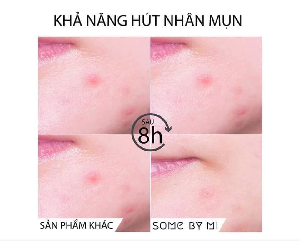 Combo 3 Miếng Dán Mụn Some By Mi Clear Spot Patch (Set 18 miếng) x 3
