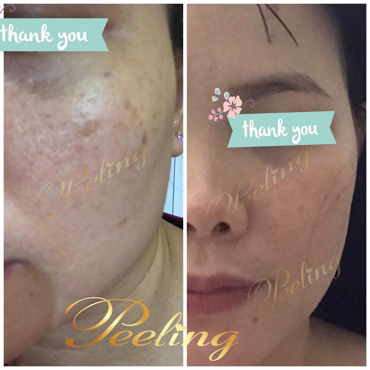 [HCM]kem Peeling Tái tạo da
