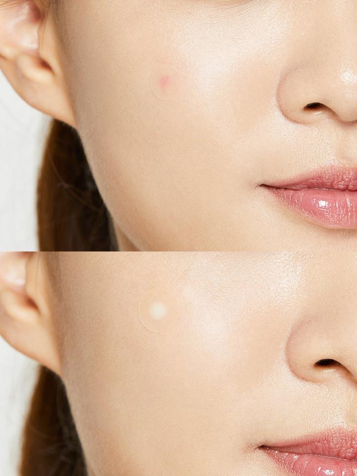 Combo 2 Miếng Dán Mụn Clear Fit + Pimple Master Patch 24 miếng
