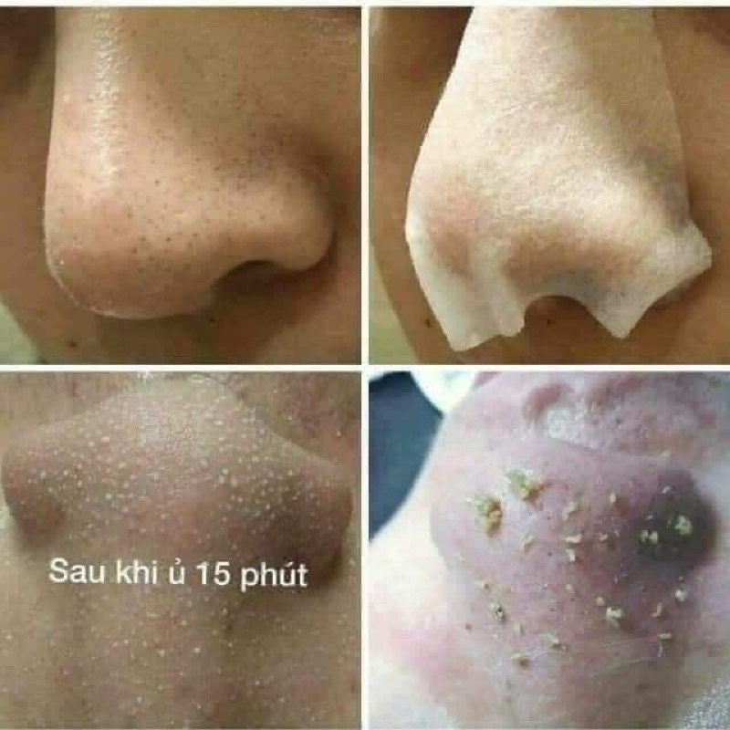 Ủ mụn đầu đen medi-peel extra super9