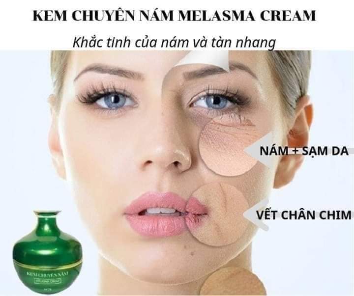 Kem Chuyên Nám huỳnh đỗ