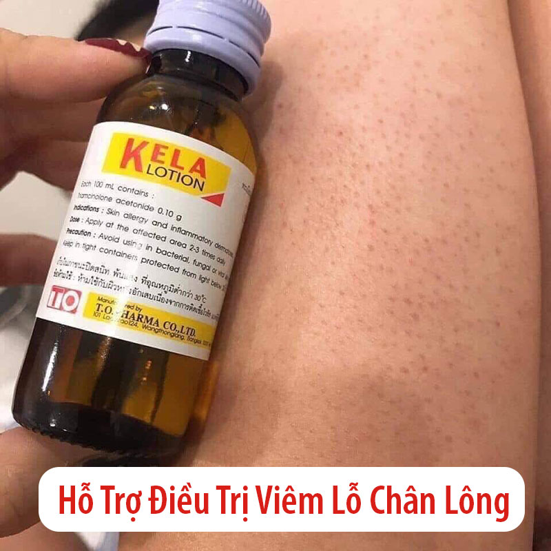 Viêm lỗ chân lông Kela Thái Lan