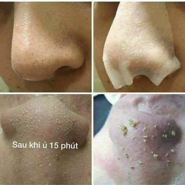 Dung Dịch Ủ Mụn Đầu Đen Medi-peel Extra Super 9 Hàn Quốc 100ml (hàng công ty)
