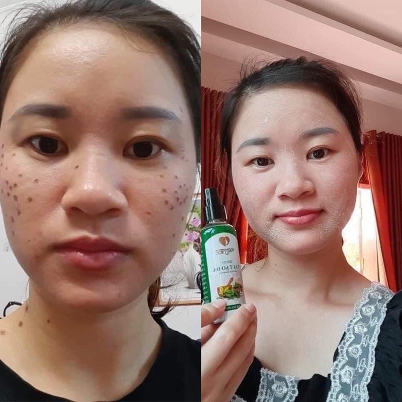 [HCM][XÃ KHO SALE OFF] Chấm Xóa Nám Rỗ Tàn Nhang YODY WHITE (Chính hãng - Số lượng có hạn)