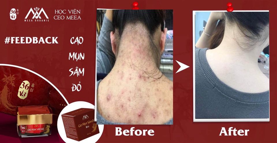 (CAO MỤN SÂM ĐỎ- CHẤM DỨT MỤN SAU 14 NGÀY FULL 15GR