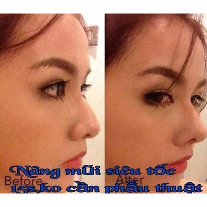 Combo 3 bộ sụn nâng mũi