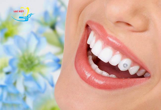 [HCM]hạt đính đá trên răng bộ 5 hạt + keo
