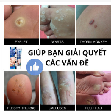 {ĐÁNH BẬT} MỤN CÓC, MỤN THỊT REMOVE EVERY WARTS