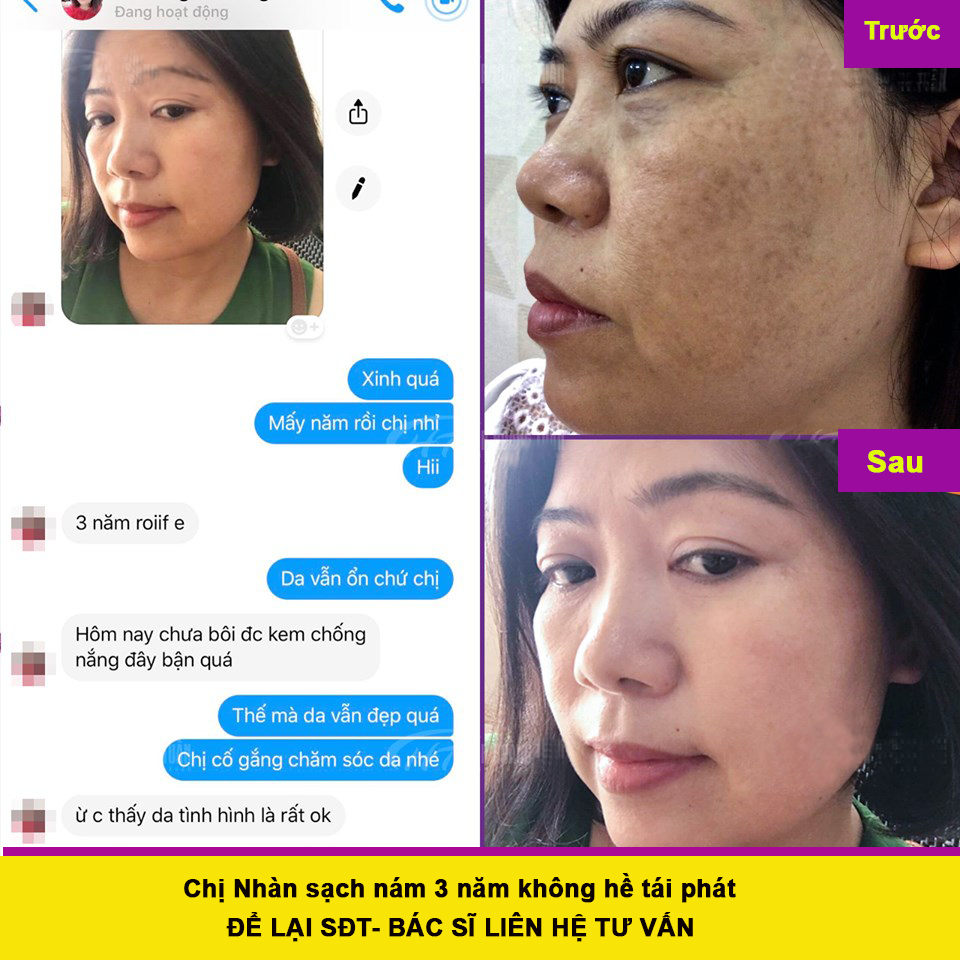 Serum trắng và chăm sóc da, Nước Cốt sâm nám Tàn Nhang