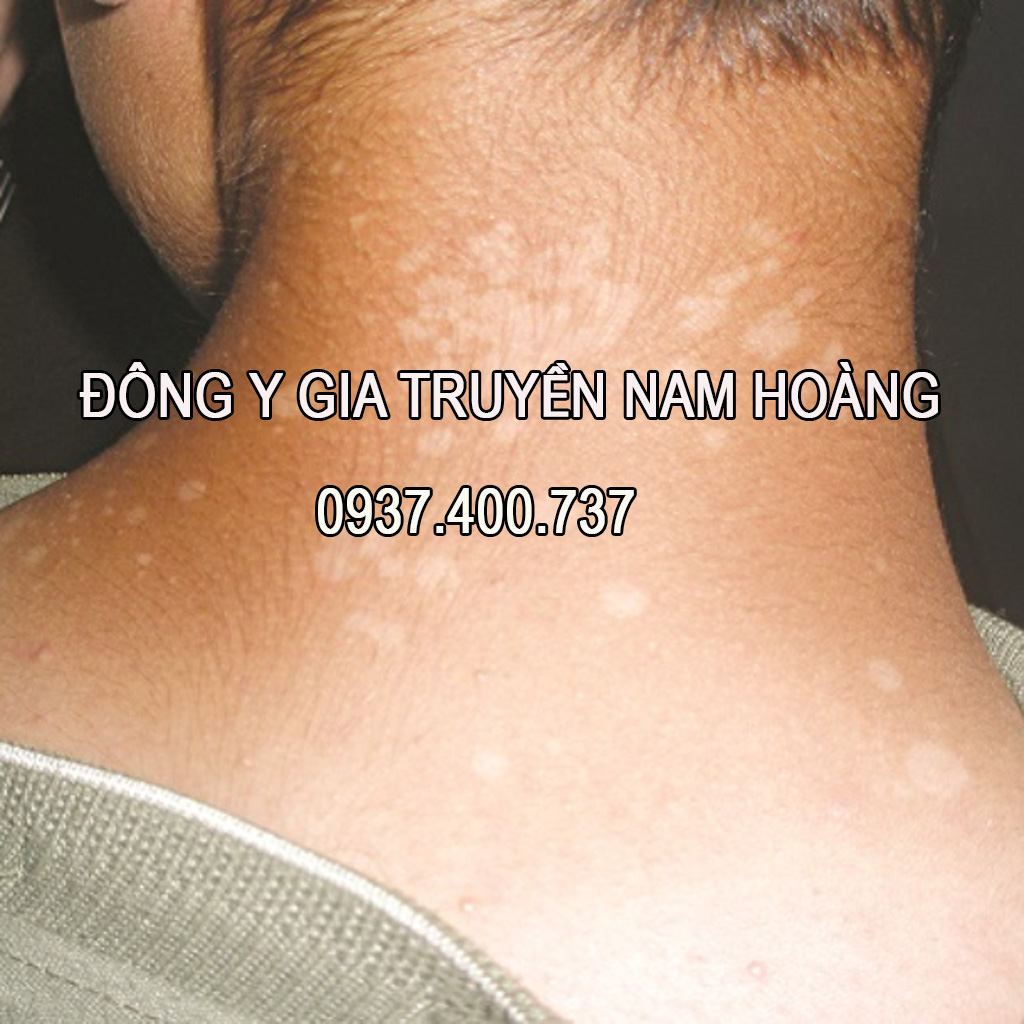 Thuốc Đặc Trị Bệnh Lang Ben Nam Hoàng