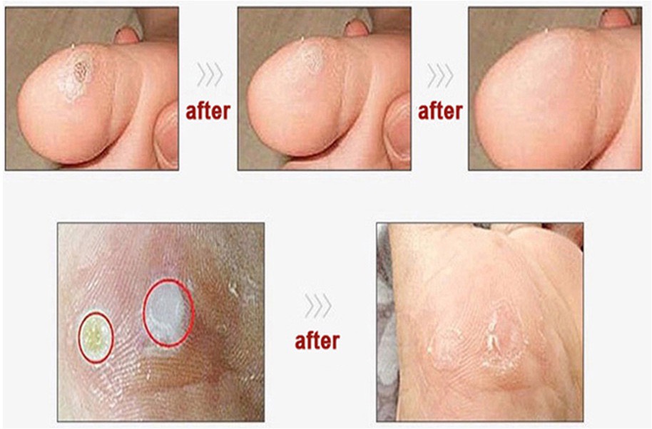 MỤN CÓC MIẾNG DÁN CORN REMOVAL PLASTER (Hộp 6 miếng)