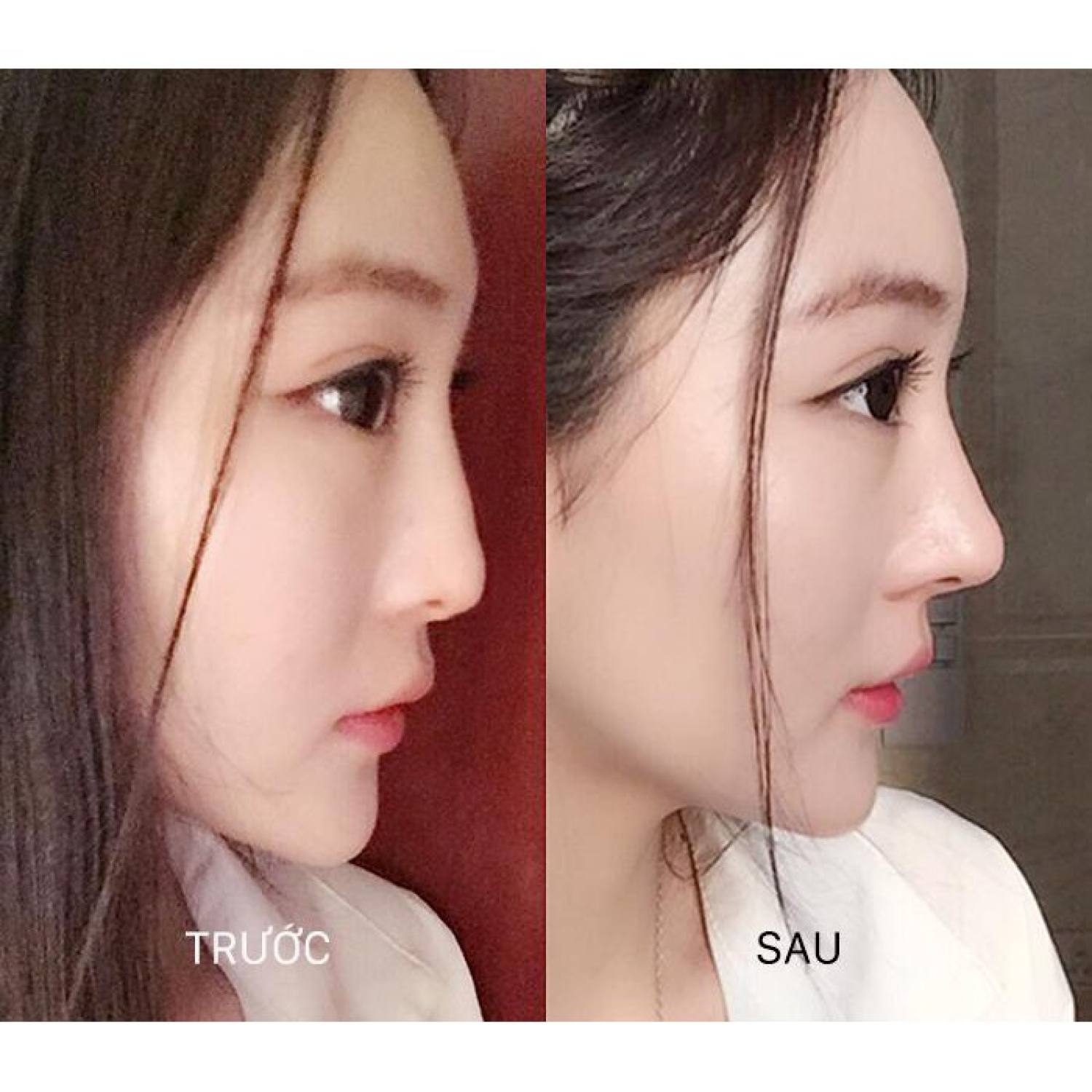 Bộ dụng cụ nâng mũi 3D Hàn Quốc