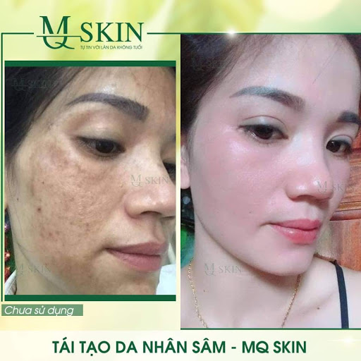 SERUM TÁI TẠO THAY DA NHÂN SÂM MQ SKIN