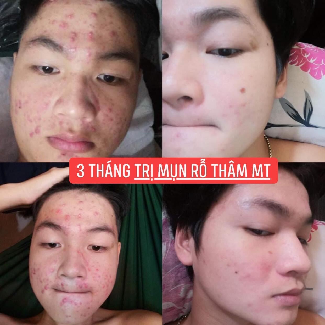 ( 2 lọ )Thảo Dược Sạch Mụn Thâm Rỗ MT (50ml)