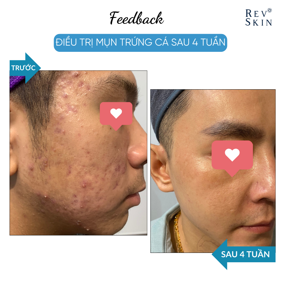 Combo Sạch Mụn RevSkin - Sữa Rửa Mặt + Kem Chấm Mụn