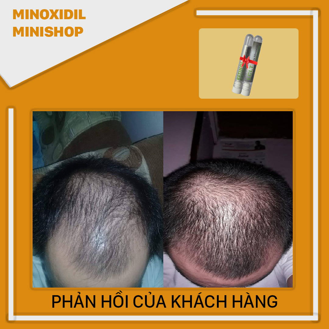 LCLT+ Retinol mix Minoxidil Giúp Mọc Râu Tóc Nhanh
