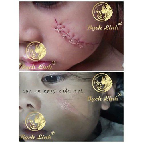 CAO SẸO BÁCH Y SÂM - CAO SẸO THẢO DƯợc BẠCH LINH ( mẫu mới cô đặc )