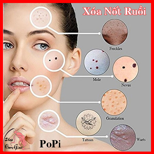 KEM TẨY MỤN CƠM, MỤN CÓC, NỐT RUỒI, MỤN THỊT, TÀN NHANG POPI