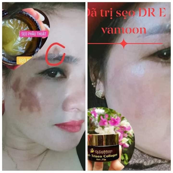 Cao sẹo collagen Dr Eva Chính Hãng