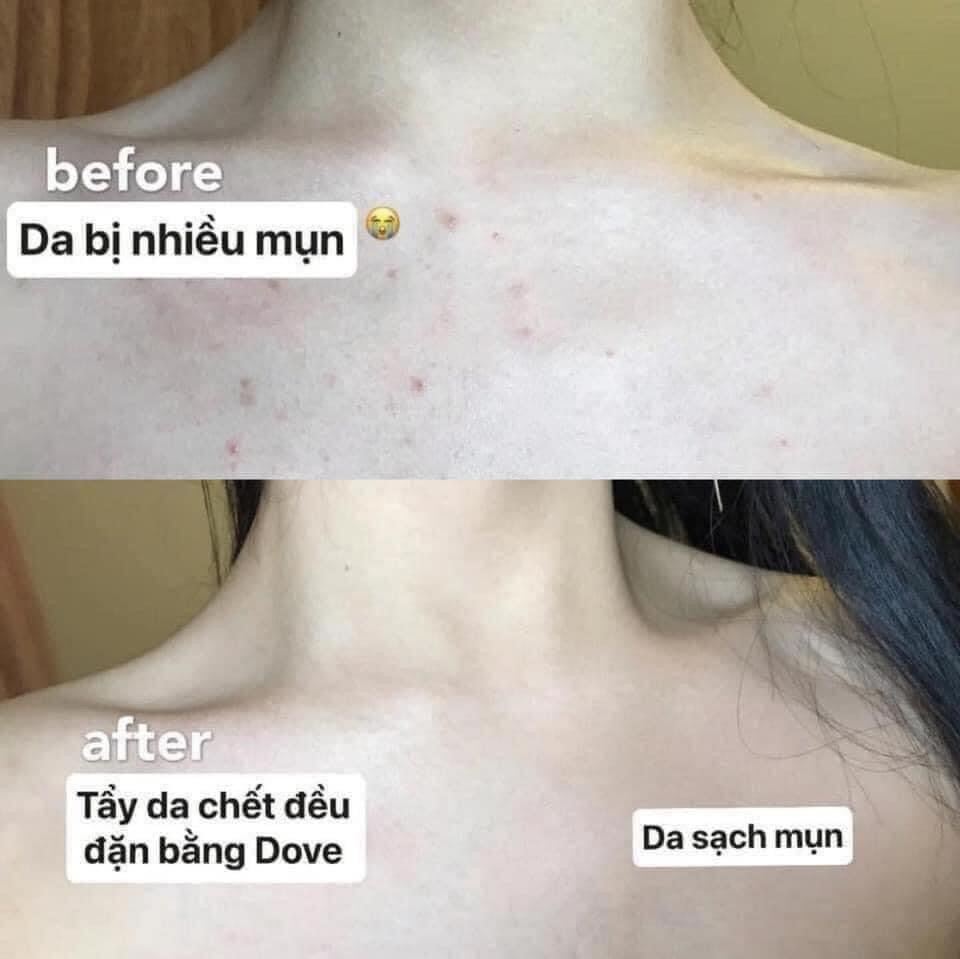 [FreeshipMAX] Tẩy Tế Bào Chết DOVE Exfoliating Body Scrub
