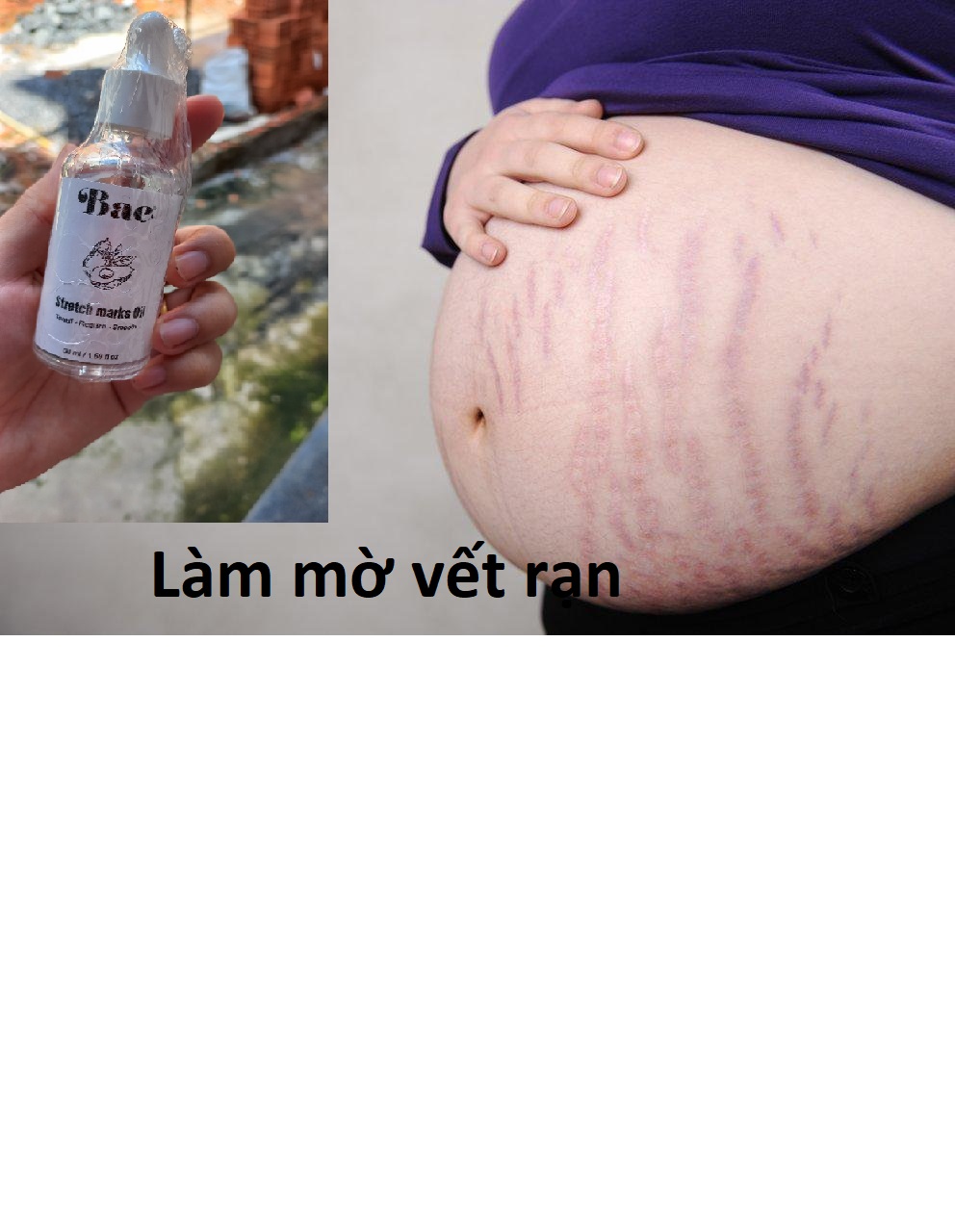 [HCM]Tinh Dầu ngăn ngừa rạn da cho bà bầu
