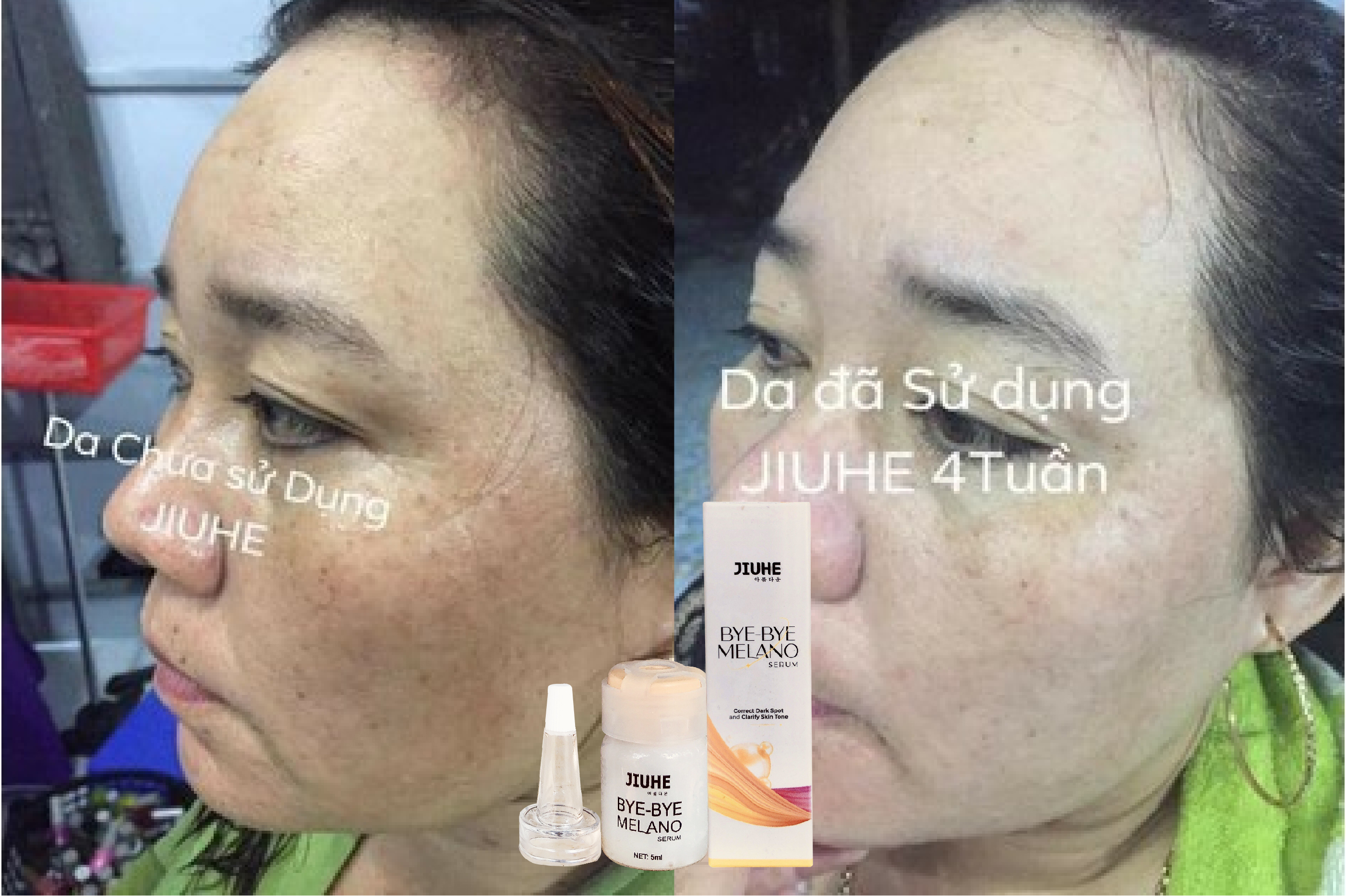 Serum xóa thâm Jiuhe 5ml