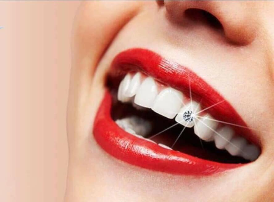 Đá Đính Răng Giá Rẻ ( kim cương nhân tạo gắn răng)