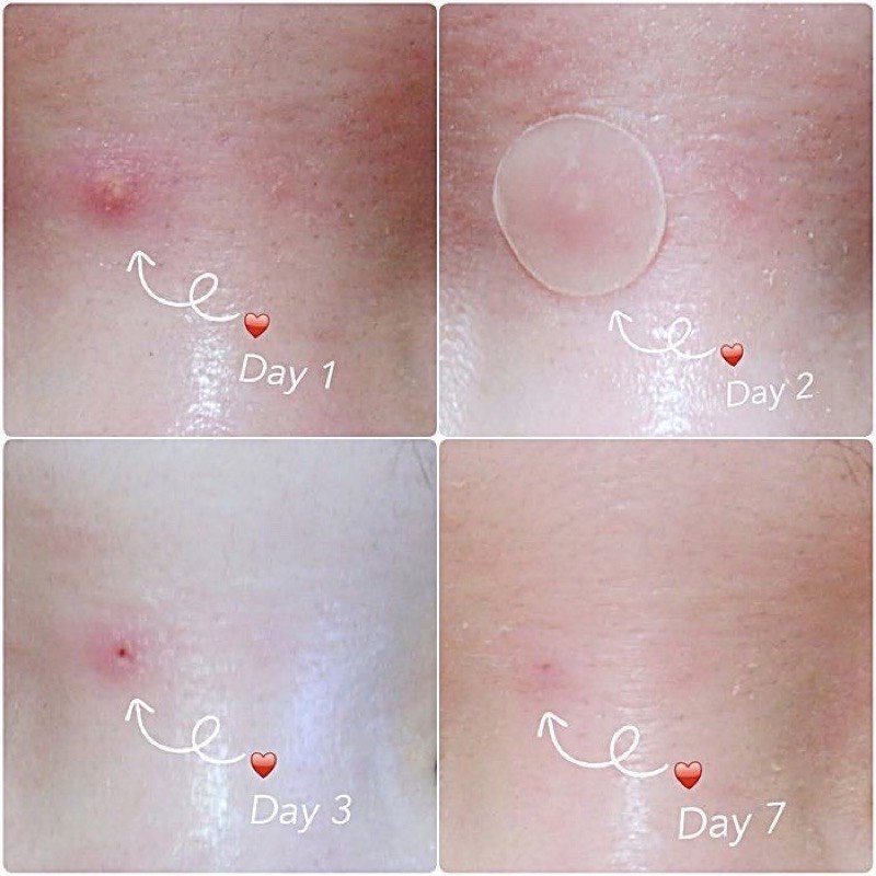COMBO 3 BỘ 108 MIẾNG DÁN CHE MỤN, CHE KHUYẾT ĐIỂM THOÁNG KHÍ