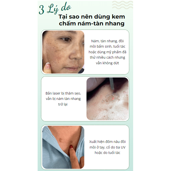Kem chấm nám - tàn nhan KT