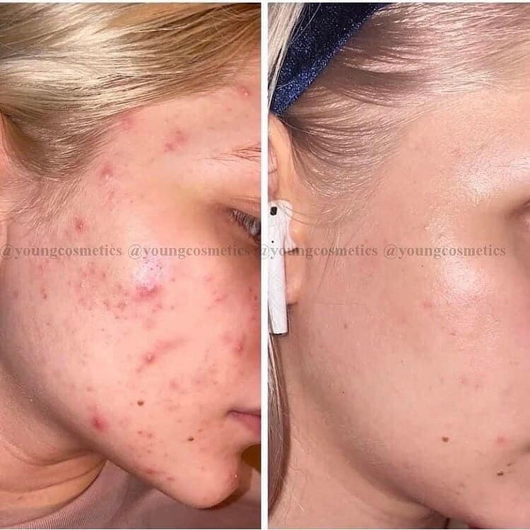 THE ORDINARY LACTIC ACID 10% + HA 30ml