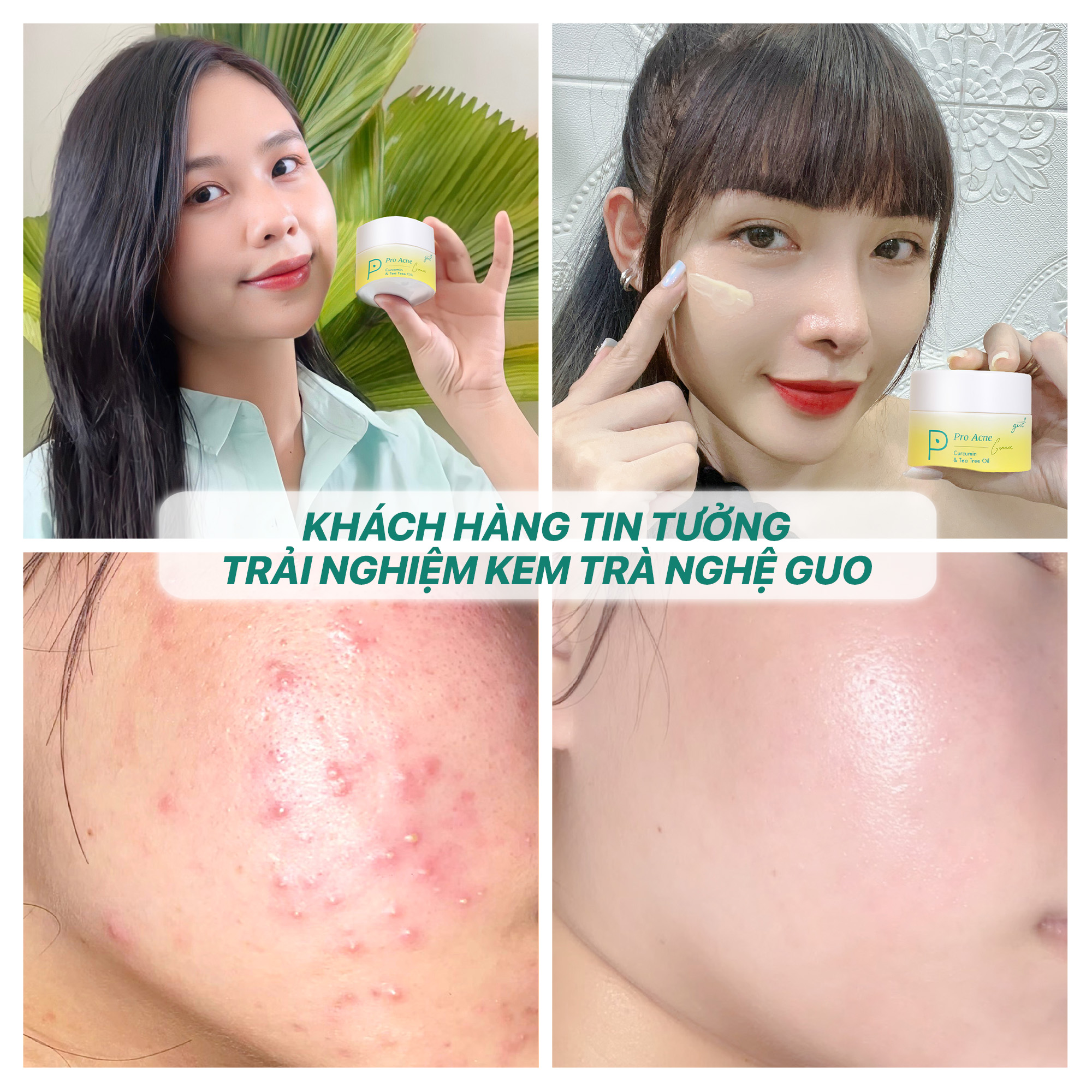[Sạch mụn ẩn, mờ thâm mụn] Kem dưỡng da mụn trà nghệ GUO 30g