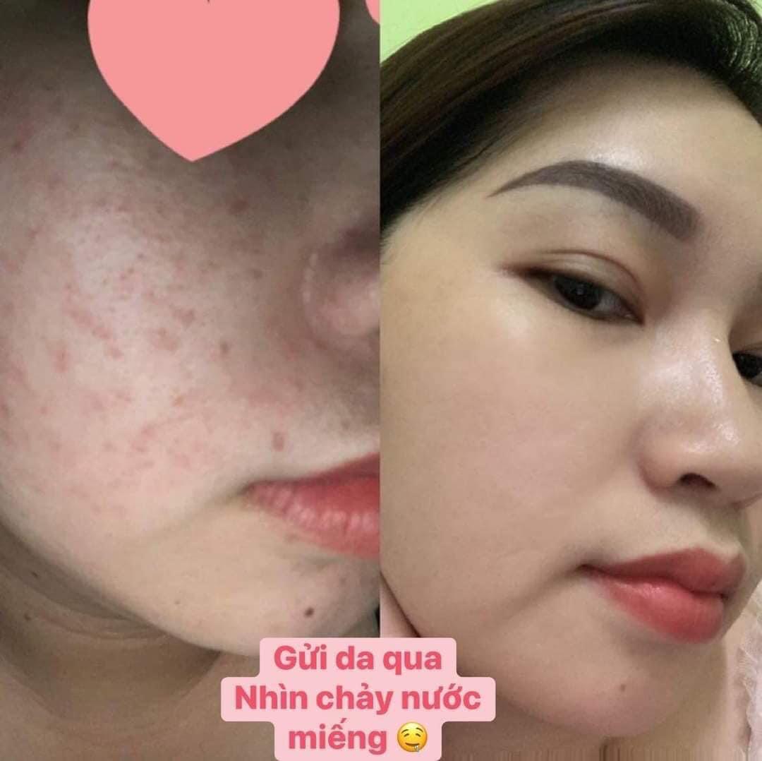 KEM FACE NANO DƯỠNG TRẮNG DA MỜ THÂM. THẢO MỘC SPA