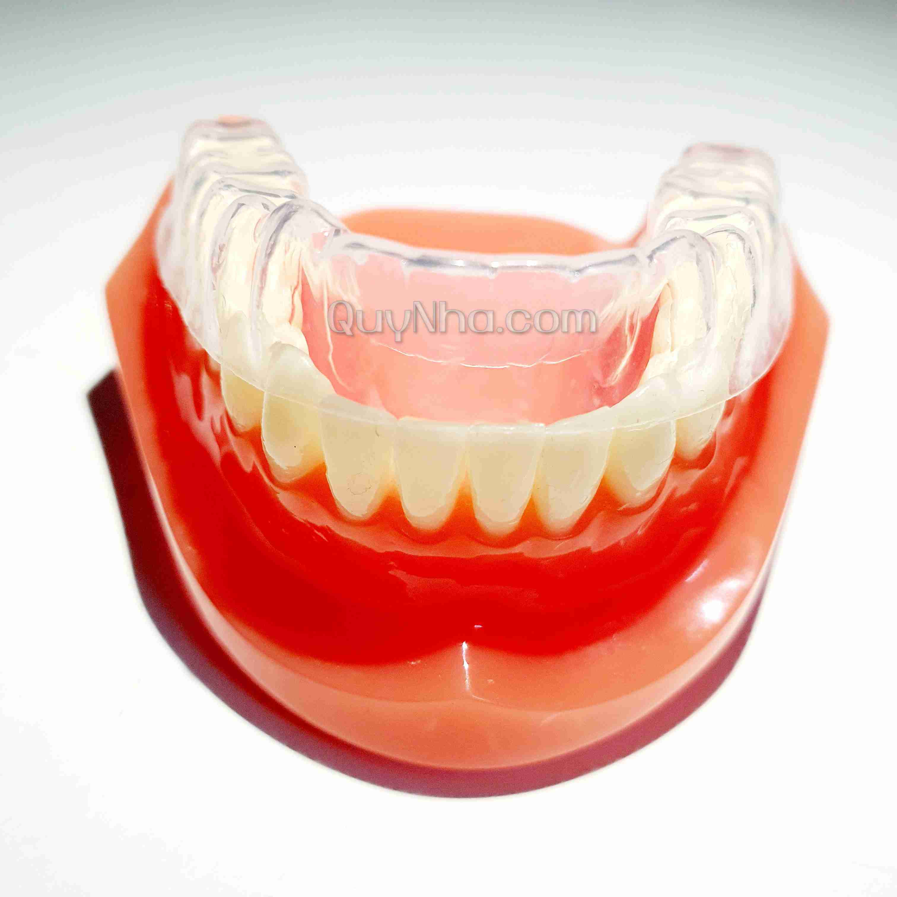 Máng tẩy trắng răng tại nhà