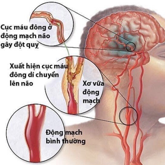VIÊN  NGĂN NGỪA ĐỘT QUỴ CARTIA