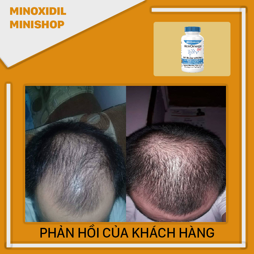 HairOmega DHT Blocker - Mọc Tóc Ngăn Rụng Tóc