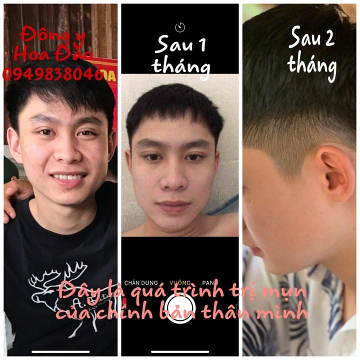 combo 5 hộp kem mụn thảo dược Hoa Đào