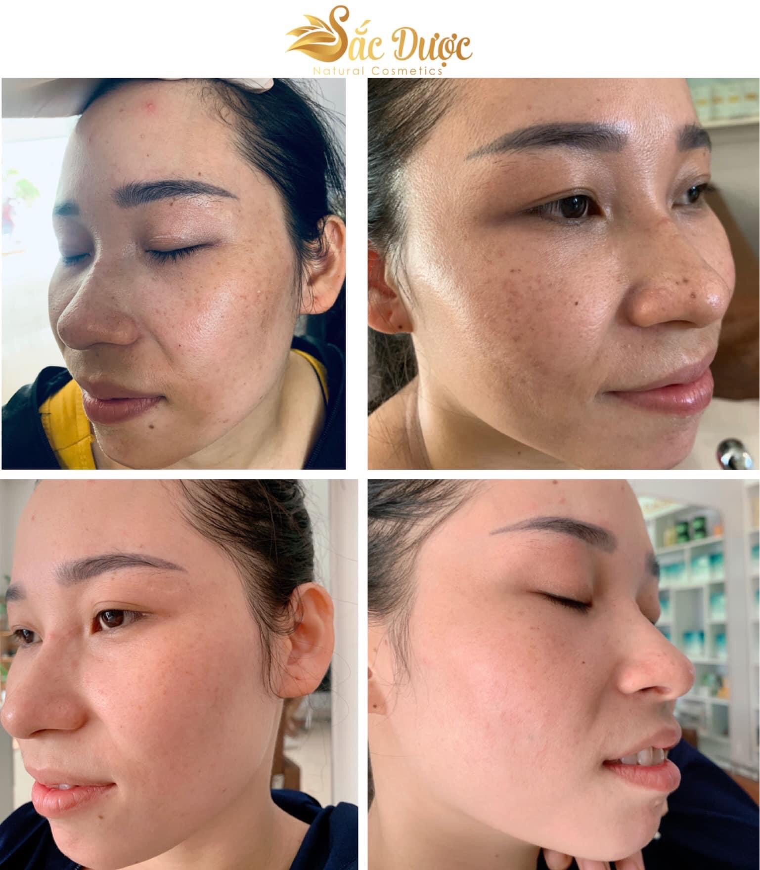 Kem Sắc Dược Ngừa Nám Sạm
