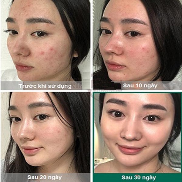 Combo 2 sản phẩm giảm mụn Some By Mi AHA-BHA-PHA 30 Days Miracle (Serum 50ml + Kem 50ml)