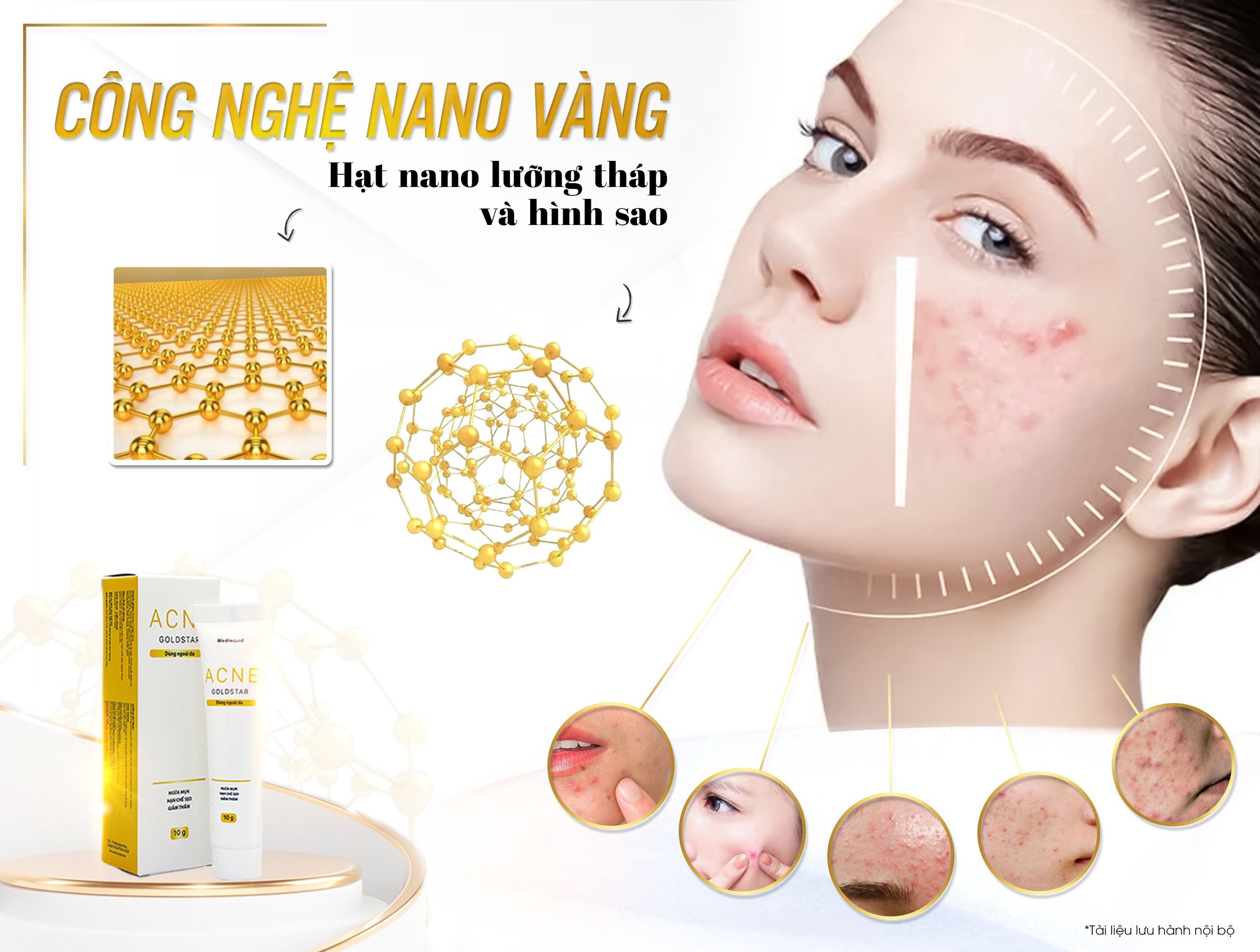 Kem mụn Acne GoldStar 10g