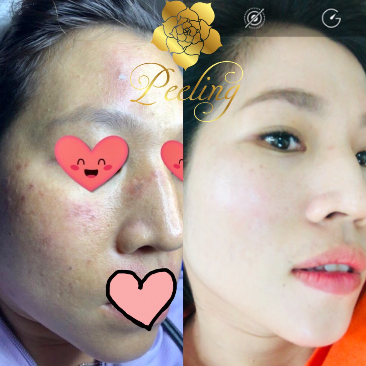 Kem Peeling Tái Tạo Da
