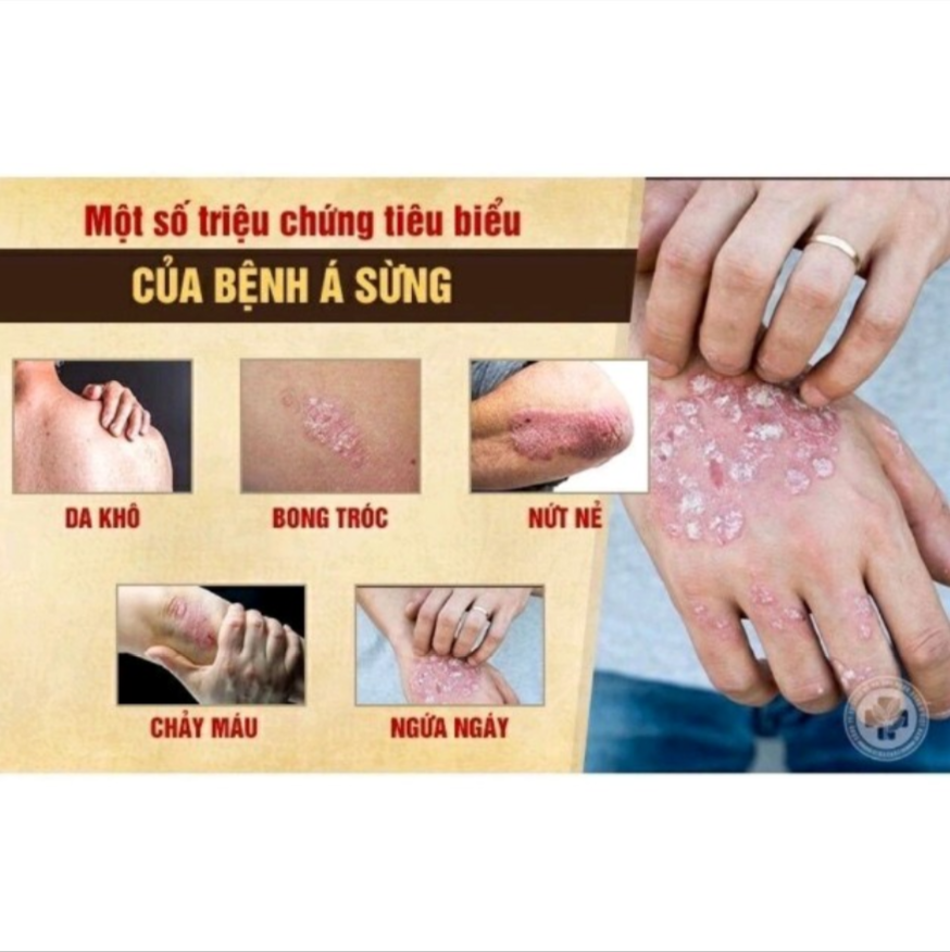 Kem bôi nấm ngứa á sừng