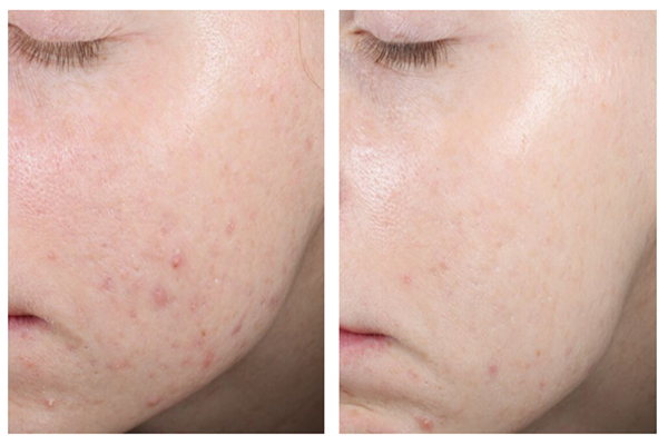 Tẩy da chết hóa học Neostrata Oily Skin Solution 8 AHA